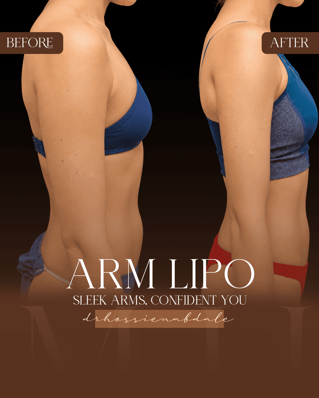 Arm liposuction before and after, side view