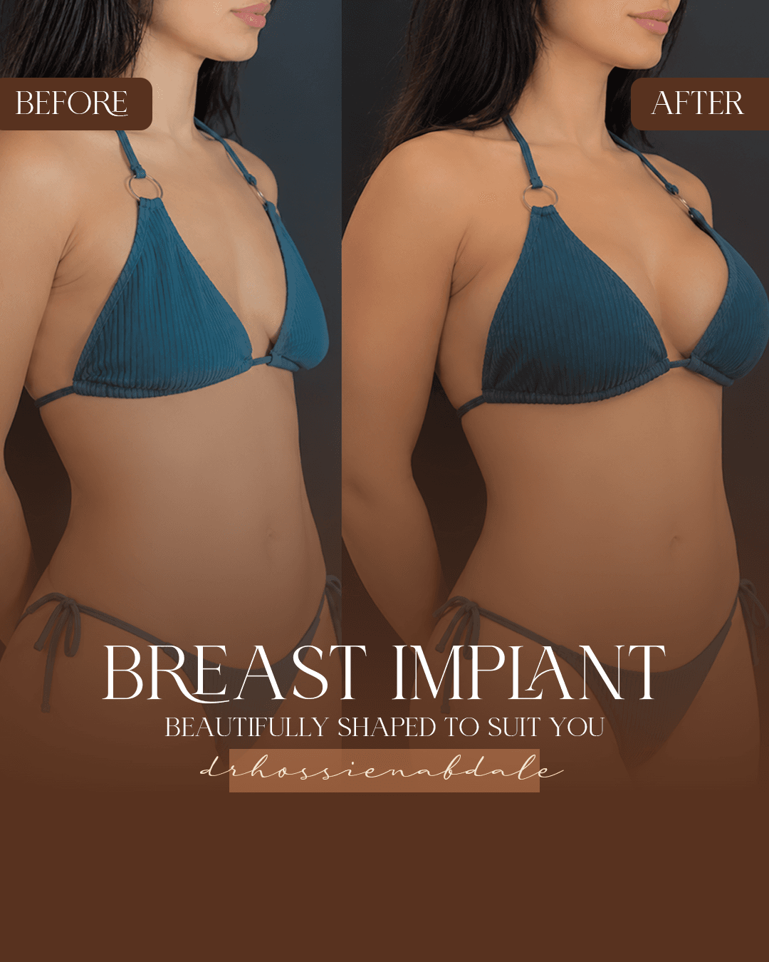 Breast implant before and after, three-quarter view