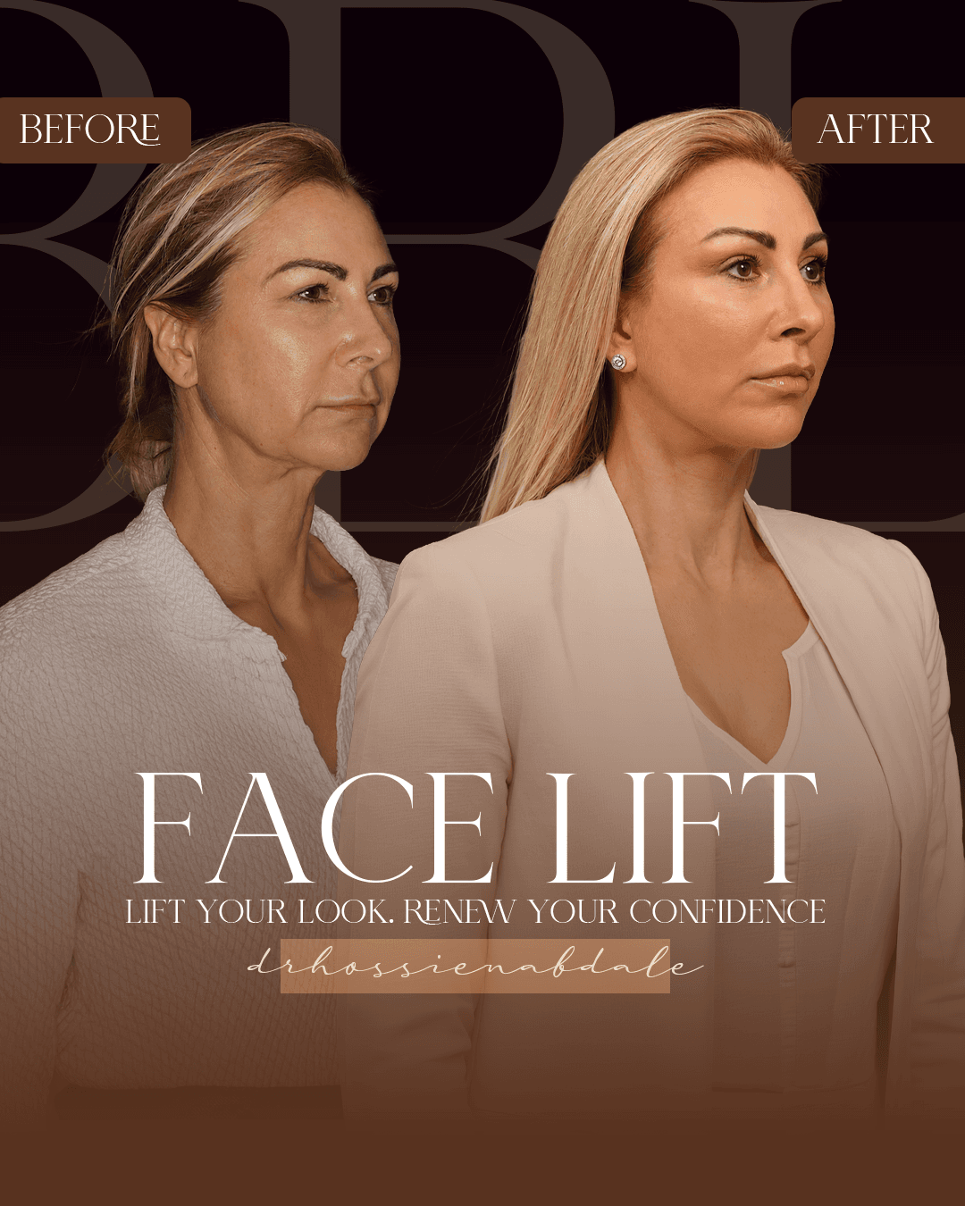 Facelift before and after, three-quarter view