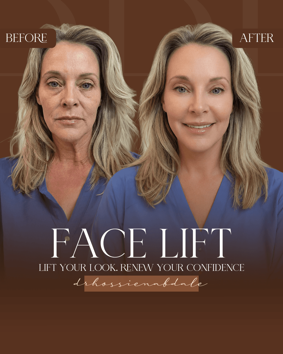 Facelift before and after, front view