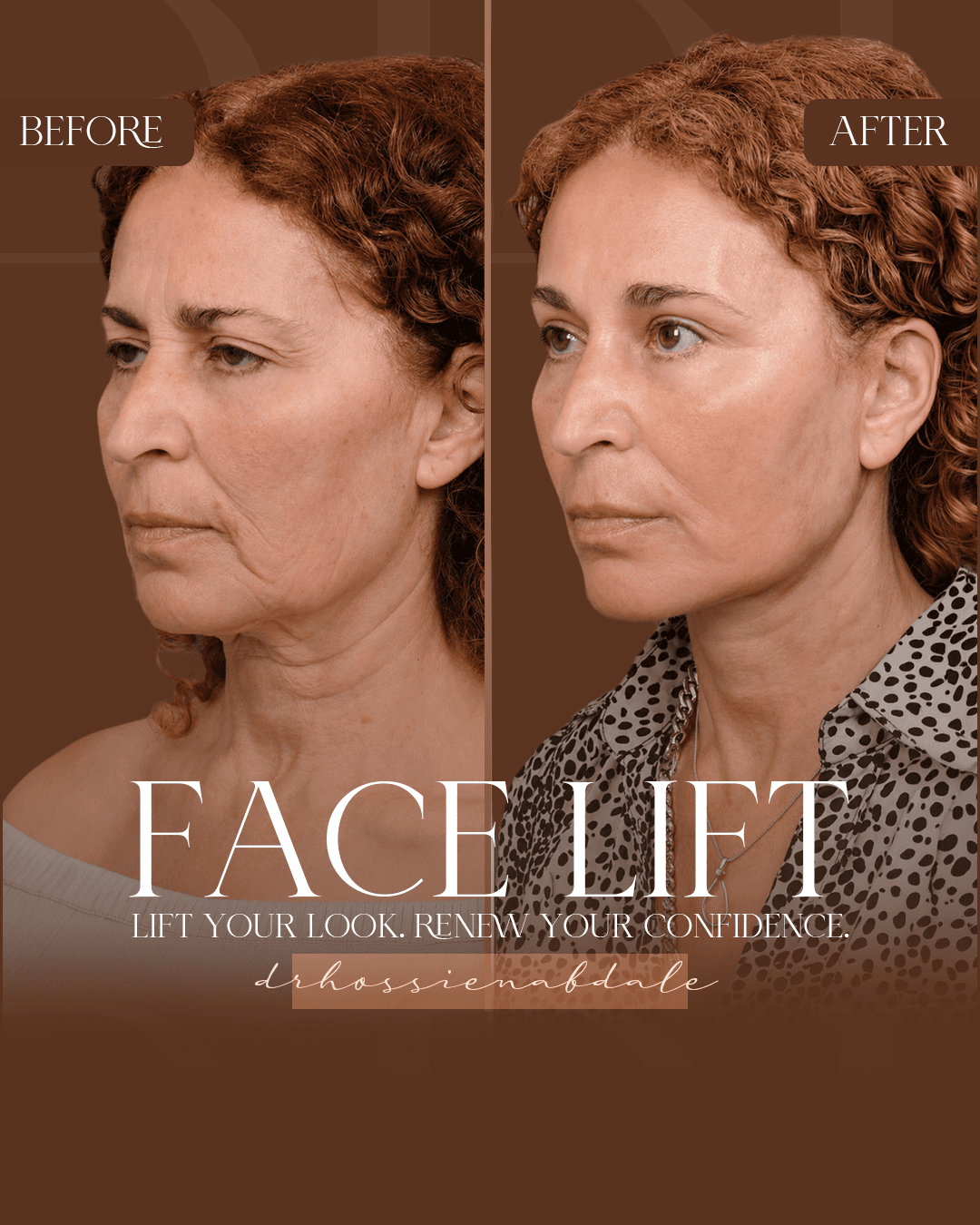 Facelift before and after, angled view