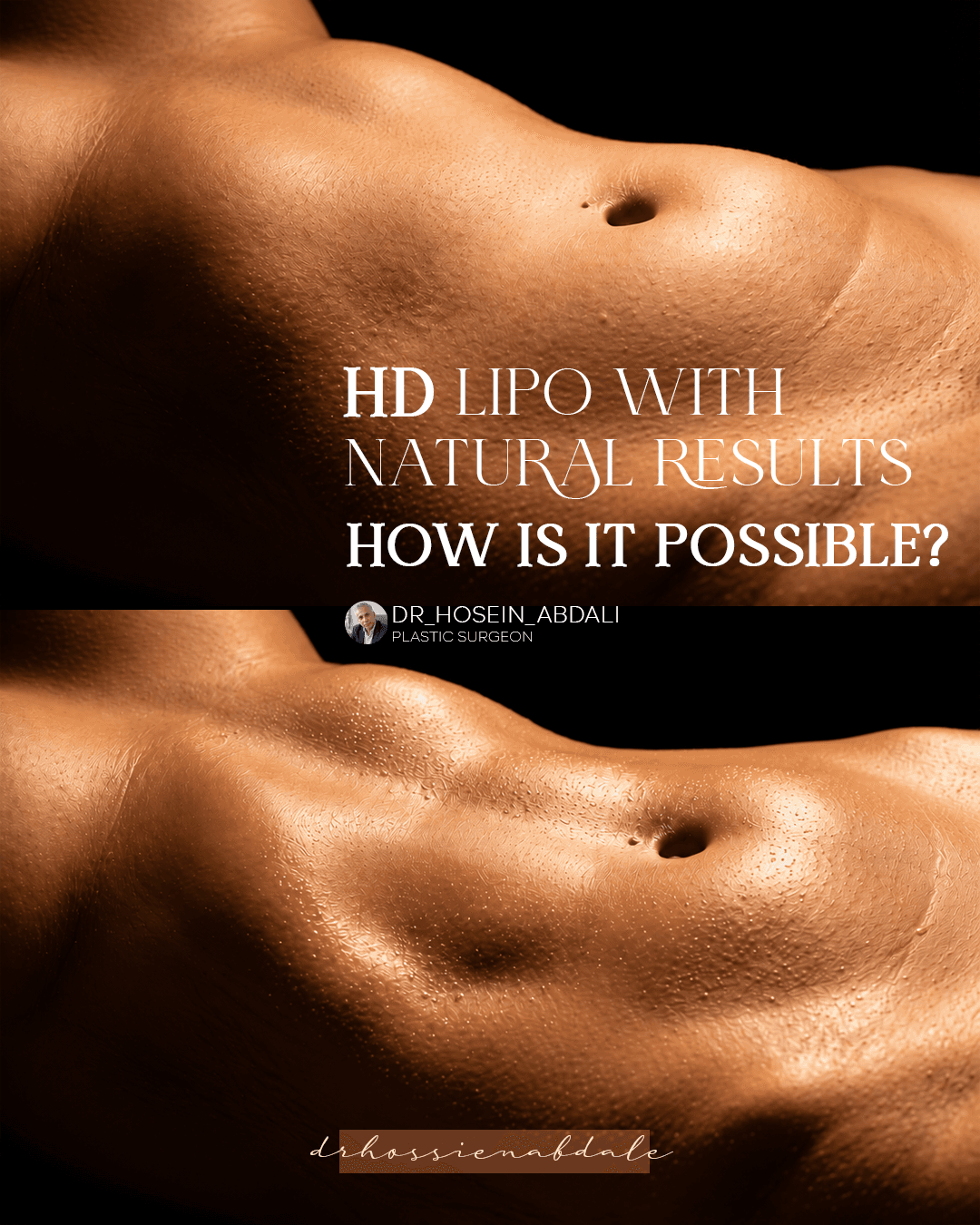 HD liposuction before and after on the abdomen