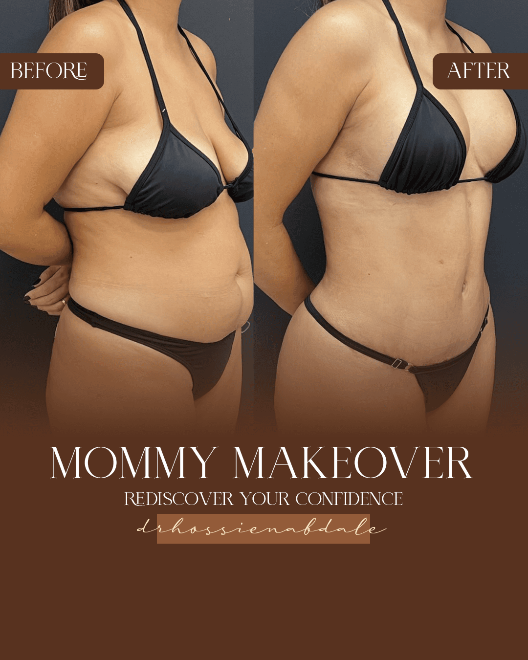 Body contouring before and after, three-quarter view