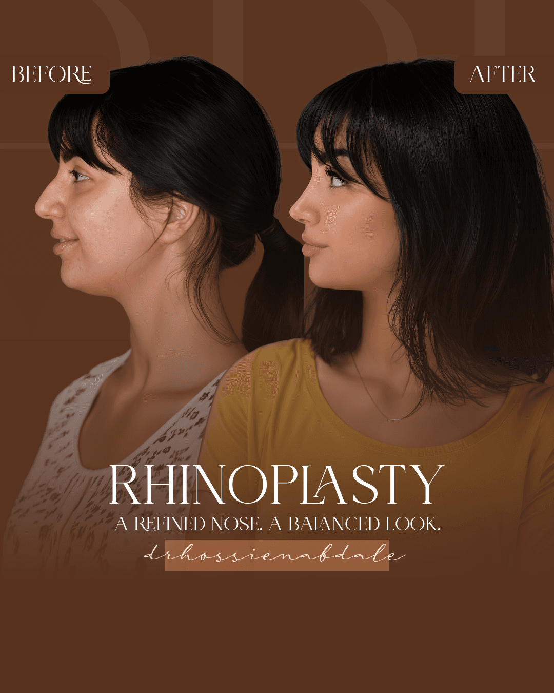 Rhinoplasty before and after, profile view
