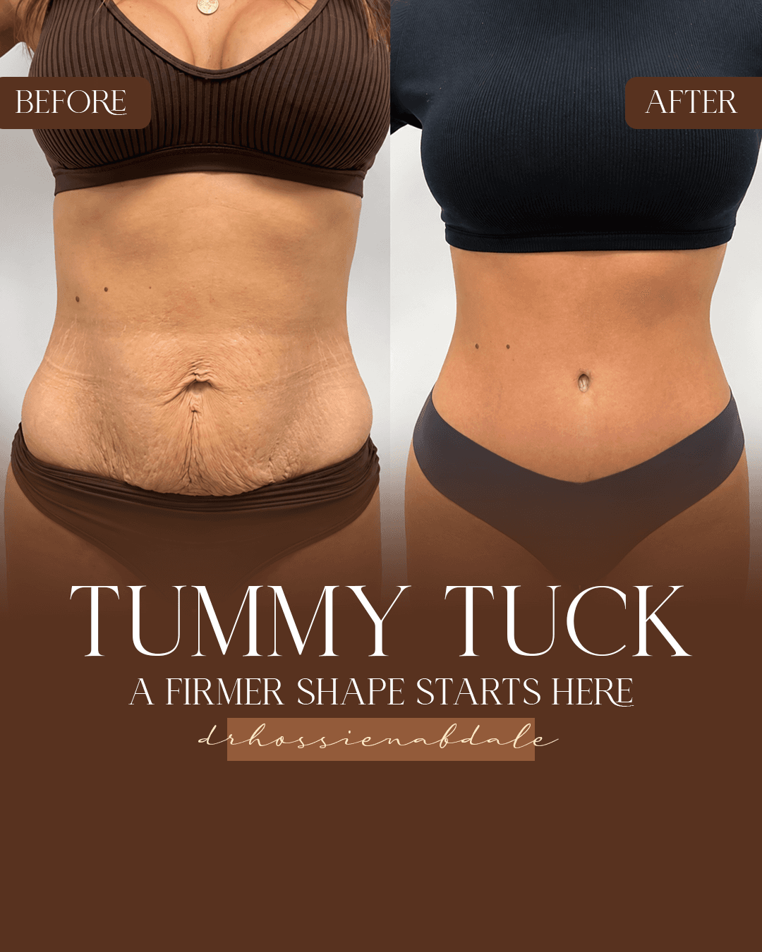 Tummy tuck before and after, front view of the abdomen